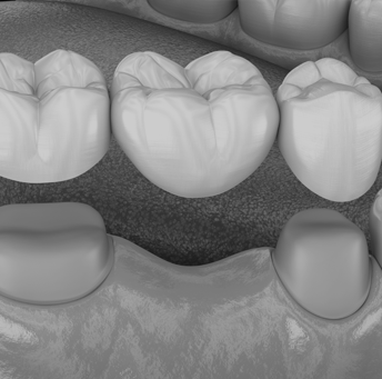 Treatment - Harrow On The Hill Dental and Facial Aesthetics