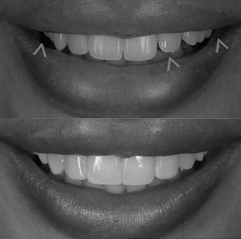 Treatment - Harrow On The Hill Dental and Facial Aesthetics